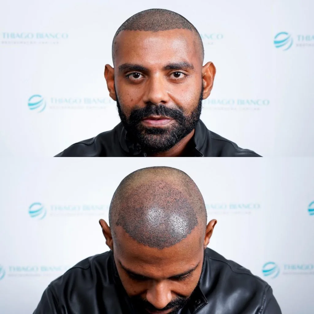 pablo transplante capilar